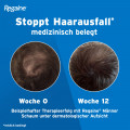 REGAINE Männer Schaum 50 mg/g bei anlagebedingtem Haarausfall